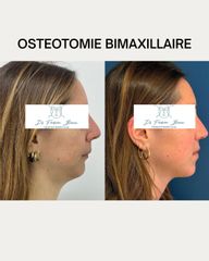 OSTEOTOMIE BIMAXILLAIRE Dr Barere