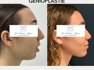 Génioplastie avant et après - 879957