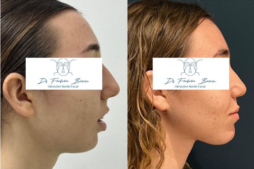 Génioplastie avant et après - 879957