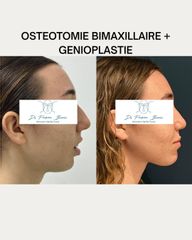 OSTEOTOMIE BIMAXILLAIRE + GENIOPLASTIE Dr Barere