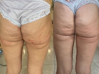 Traitement anti-cellulite avant et après - 853990