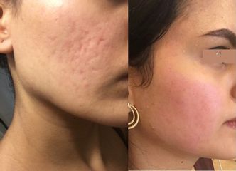 Traitement anti-acné - Dr Catherine Dropsy