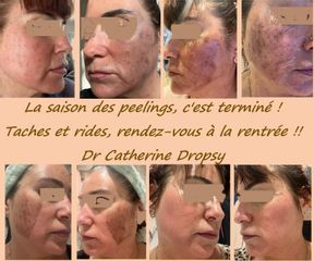 Peeling - Dr Catherine Dropsy