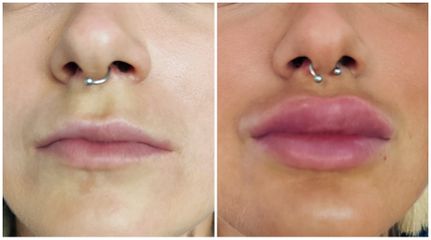 Augmentation des lèvres - Dr Catherine Dropsy