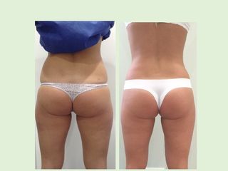 Avant après Coolsculpting