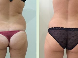 Avant après Cryolipolyse