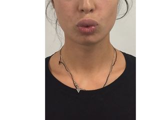Augmentation des lèvres par acide hyaluronique