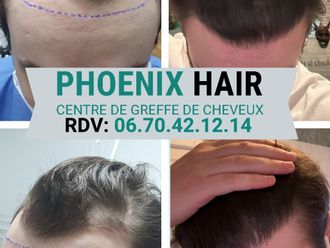 Greffe de cheveux avant et après - 876684