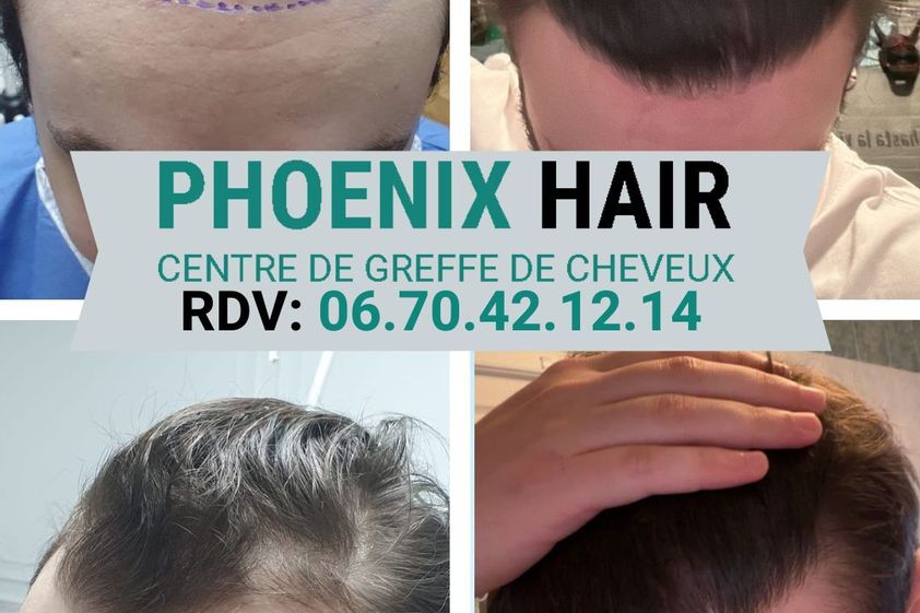 Greffe de cheveux avant et après - 876684