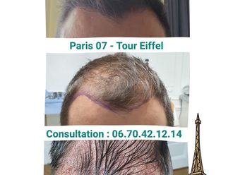 Greffe de cheveux avant et après - 876685