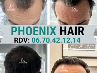 Greffe de cheveux avant et après - 876686