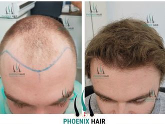 Greffe de cheveux avant et après - 878945