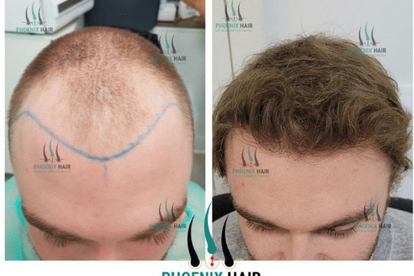 Greffe de cheveux avant et après - 878945