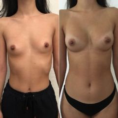 Augmentation mammaire composite - Dr Christophe Reinbold