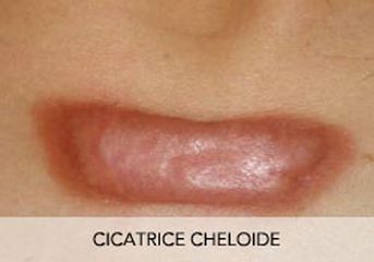 Cicatrice cheloïde