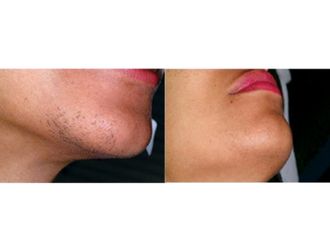 Épilation Laser - 545079
