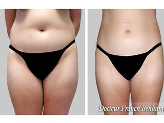 Avant après Abdominoplastie