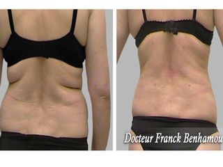 Avant après Liposuccion