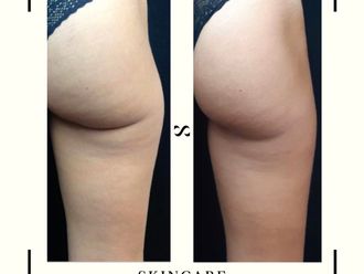Traitement anti-cellulite avant et après - 821938