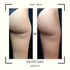 Traitement anti-cellulite - Centre de Médecine Esthétique - Skincare Agency
