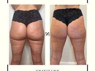 Traitement anti-cellulite avant et après - 821948