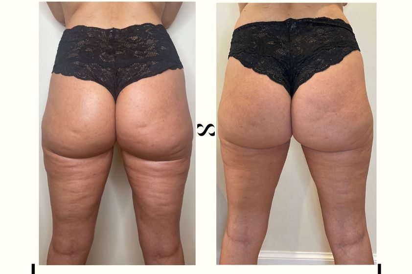 Traitement anti-cellulite avant et après - 821948