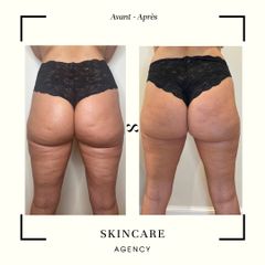 Traitement anti-cellulite - Centre de Médecine Esthétique - Skincare Agency