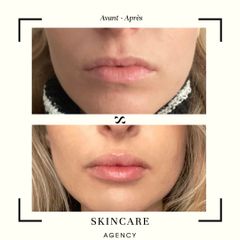 Augmentation des lèvres - Centre de Médecine Esthétique - Skincare Agency