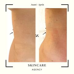 Cryolipolyse - Centre de Médecine Esthétique - Skincare Agency