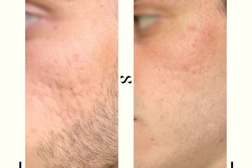 Microneedling avant et après - 821963