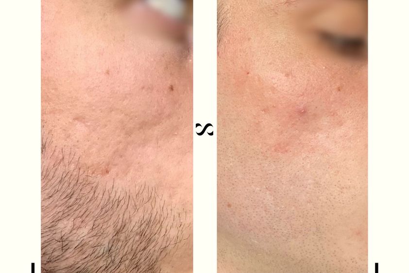 Microneedling avant et après - 821964