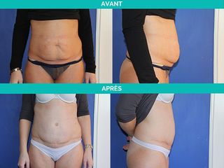 Avant après Abdominoplastie