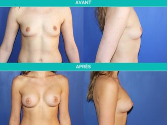 Implants mammaires avant et après - 544956