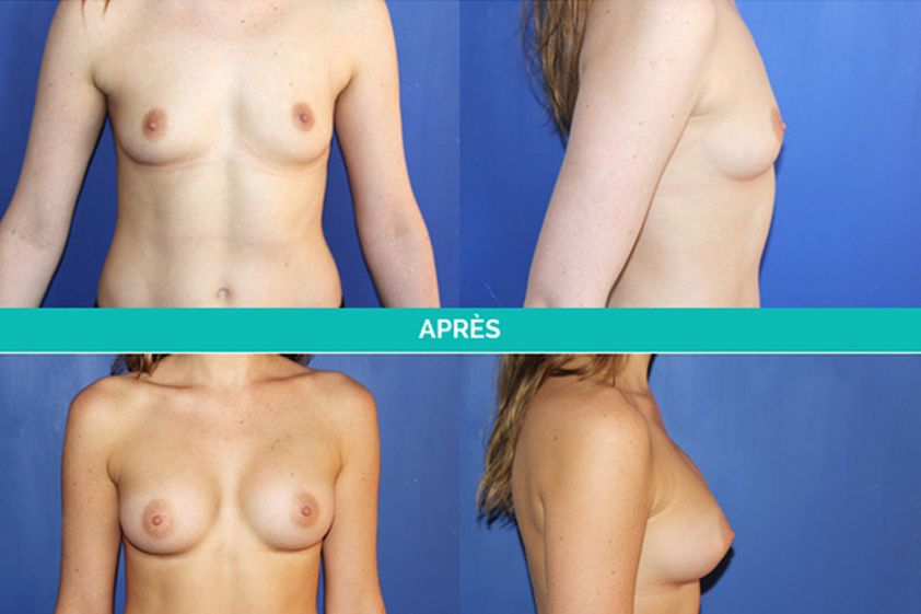 Implants mammaires avant et après - 544956