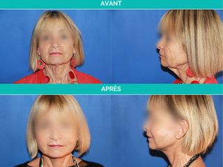 Avant après Lifting