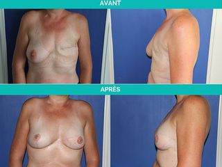 Avant après Reconstruction mammaire