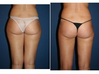 Avant après Liposuccion