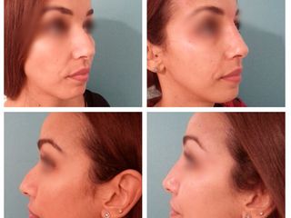 Avant après rhinoplastie médicale 