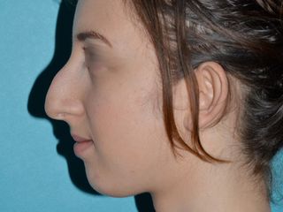 Rhinoplastie avant 