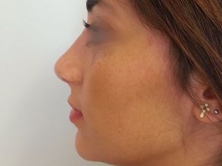 Rhinoplastie photo post operatoire