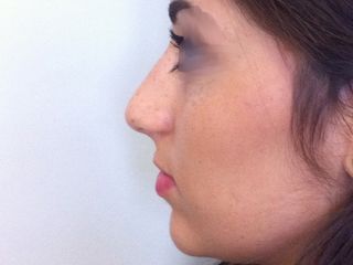 Rhinoplastie photo pre opératoire 