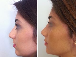 Avant après Rhinoplastie: harmonisation du dorsum et travail de pointe