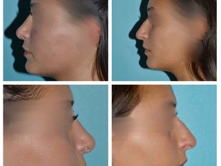 Avant après Rhinoplastie