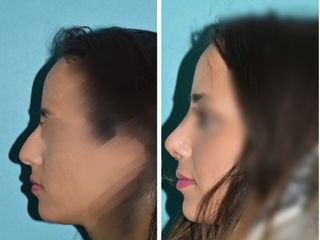 Avant après Rhinoplastie