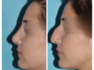 Avant après Rhinoplastie