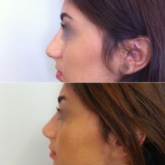 rhinoplastie d'harmonisation, adoucissement du profil