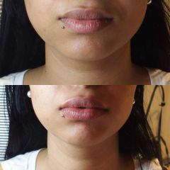 Augmentation des lèvres - Dr Salam Haidar