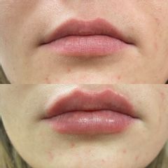 Augmentation des lèvres Russian Lips - Dr Salam Haidar