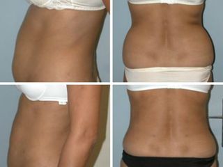 Avant après Liposuccion ceinture abdominale