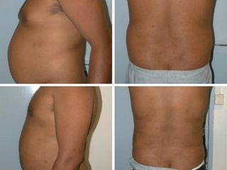 Avant après Liposuccion ceinture abdominale
